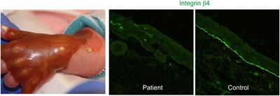 Update on Genetic Conditions Affecting the Skin and the Kidneys